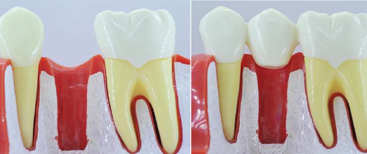 Comment remplacer une dent absente ?