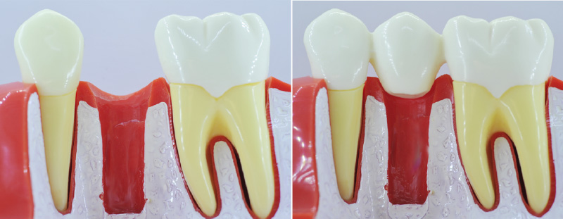 Comment remplacer une dent absente ?